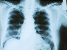 Mens health month 2015-xray