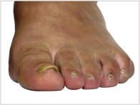 What is Psoriasis and how to treat it-nails