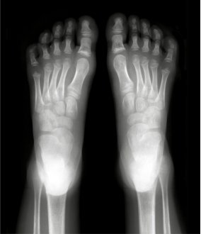 Foot Care-Pharmacy Corner-bones